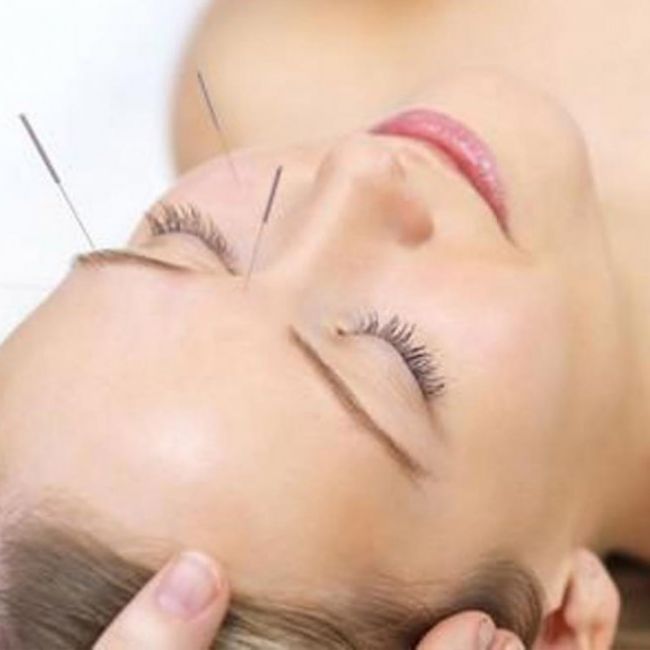Lifting facial con Acupuntura