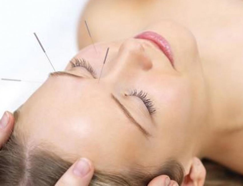 Lifting facial con Acupuntura